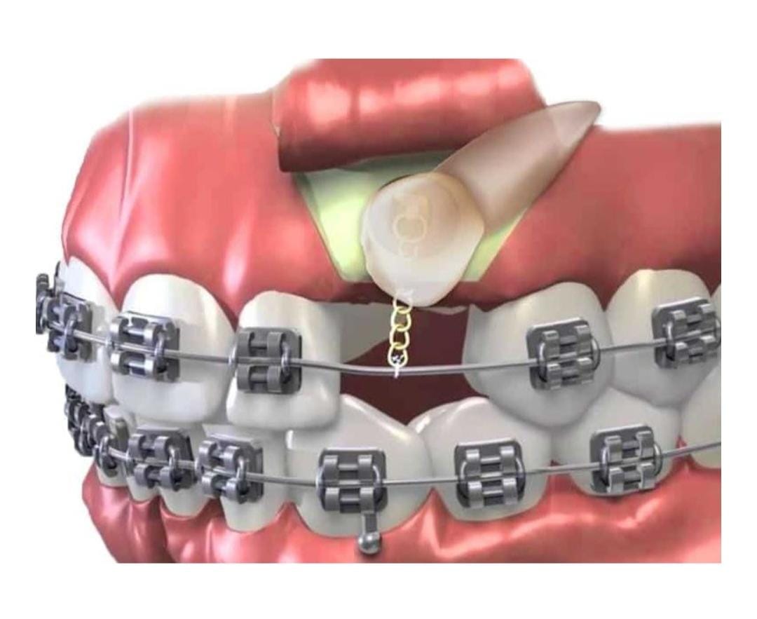 Orthodontic tooth exposure